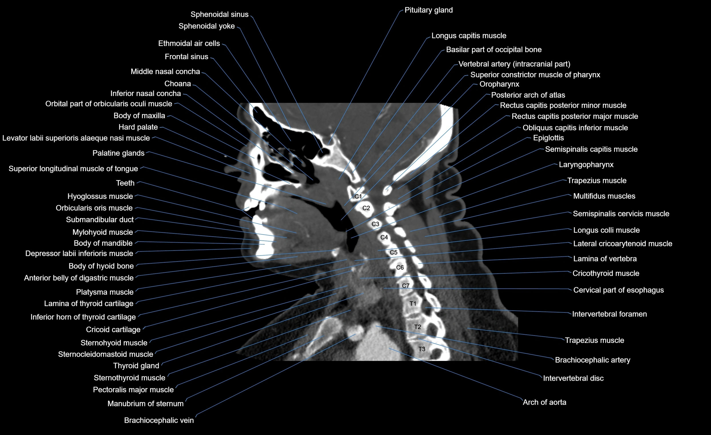Neck CT sagittal cross sectional anatomy 3D  radiology  image-img-00001-00005.webp